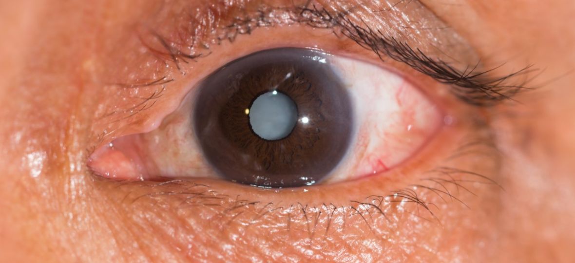 Lentes de Contato