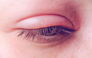 Edema Palpebal (Inchaço da Palpebra)